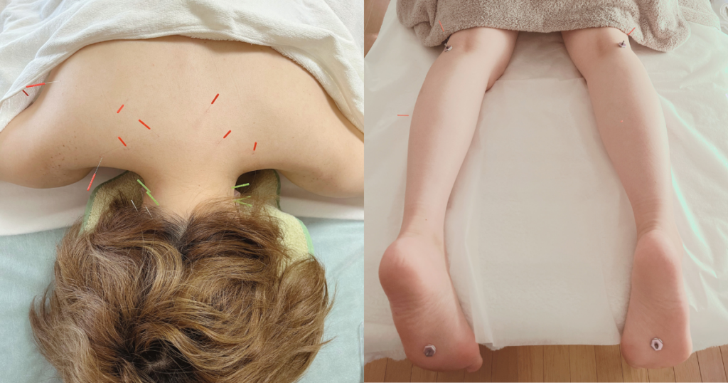 首や肩、足に鍼灸をしている様子