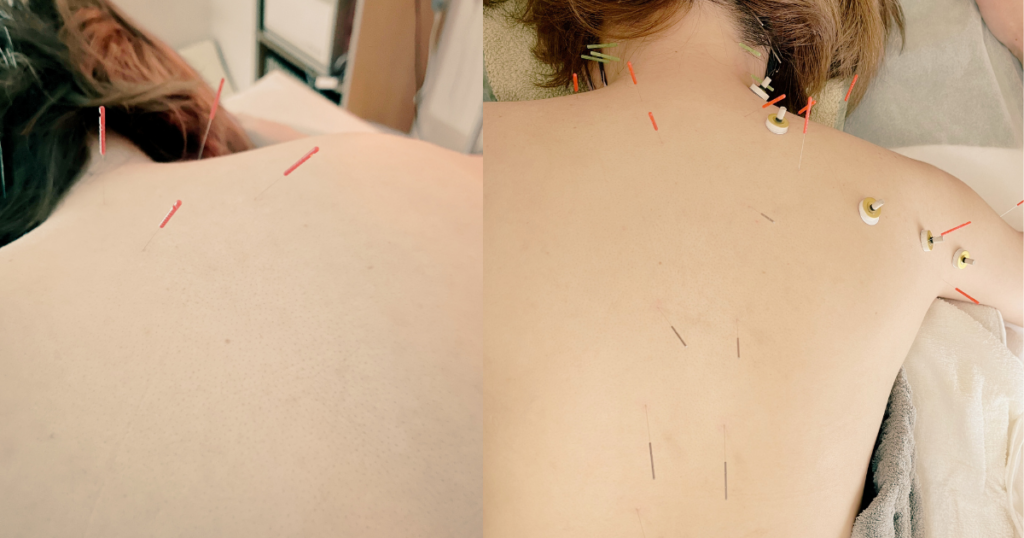 鍼灸を受けている女性の写真