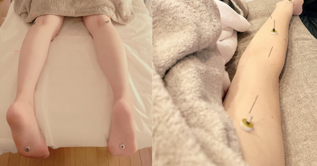 足や腕に鍼灸をしている写真